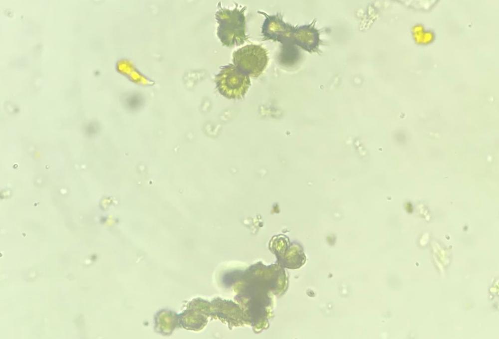 Figure 11. Ammonium biurate crystals. (Courtesy of Dr Sree Varsha)