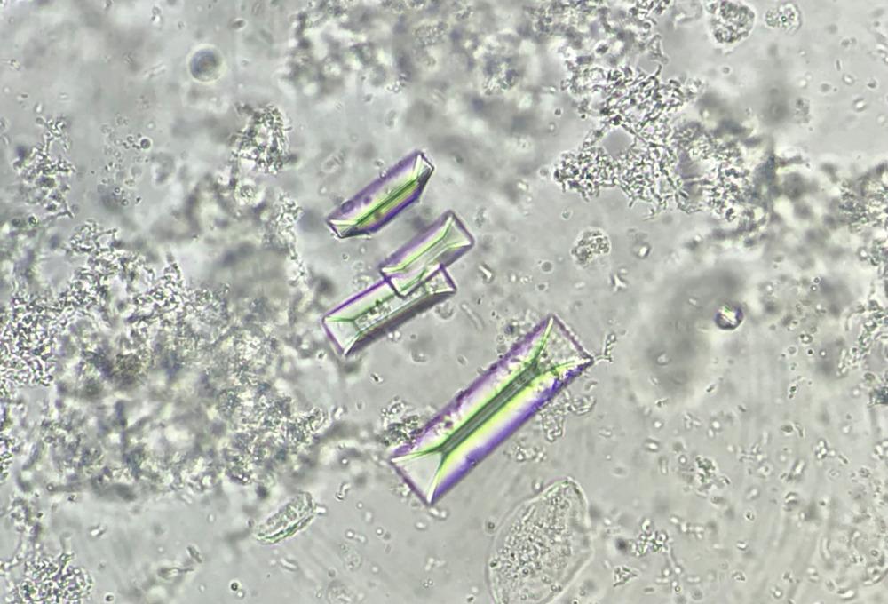 Figure 9. Struvite crystals amidst a background of granular casts. (Courtesy of Dr Sree Varsha)