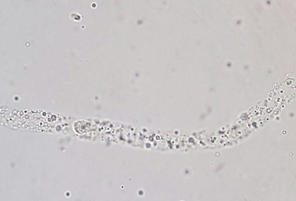 Figure 5. Hyaline cast.