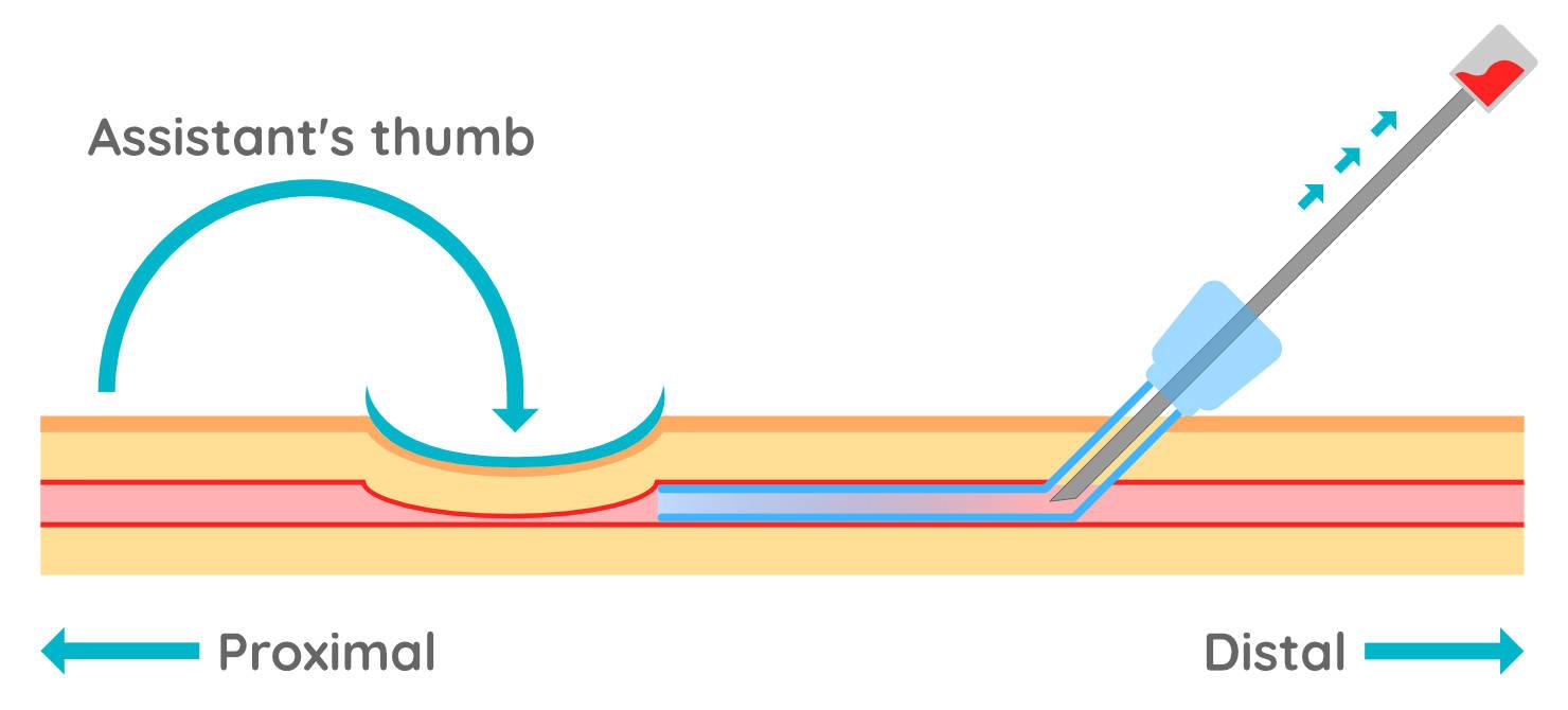 Figure 7 - Once the catheter has been fully inserted into the vein, the assistant can stop raising. If they move their hand to occlude the vein over the location where the catheter is placed, it will reduce the back-flow of blood when the stylet is removed.