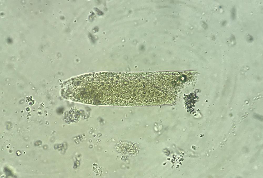 Figure 7. A granular cast (courtesy of Dr Sree Varsha).