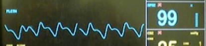 Figure 15 - Plethysmograph waveform from a pulse oximeter.