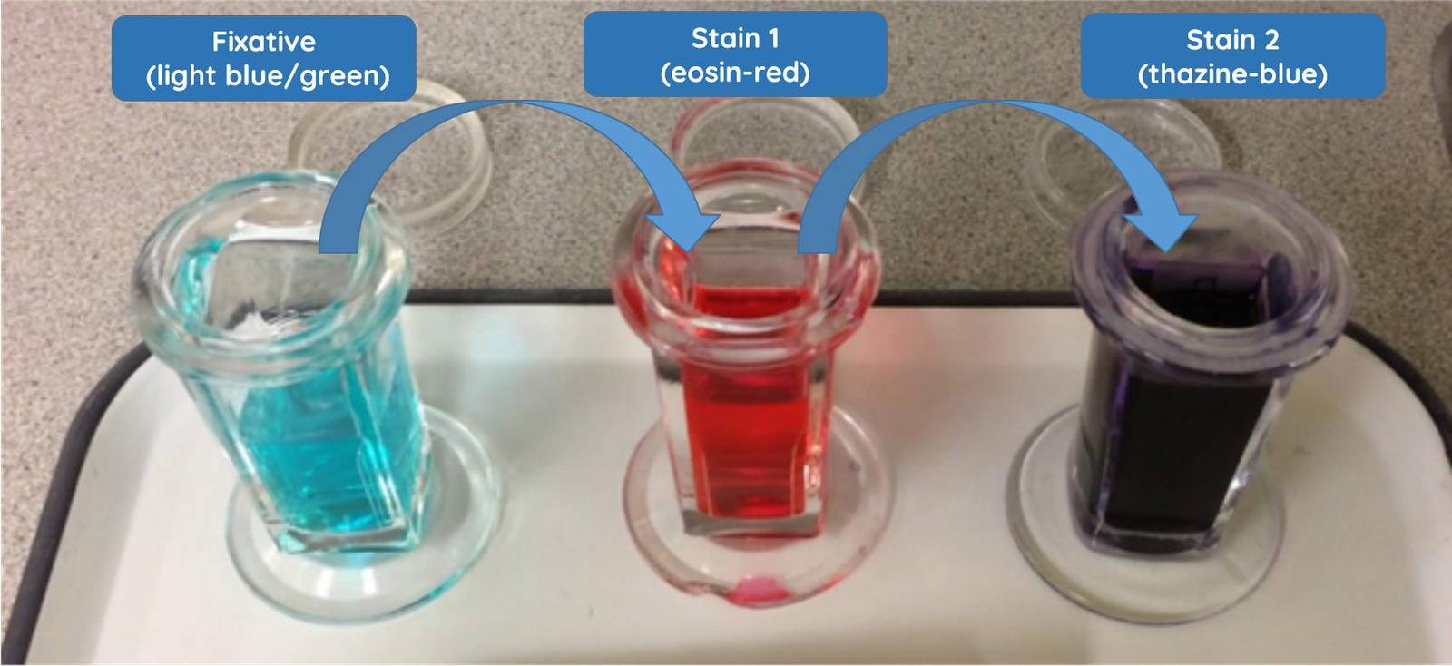 Figure 1 — The three stains required for the Diff-Quik staining technique