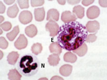 Figure 4 — A neutrophil (N) next to an eosinophil (E); note the larger size of the eosinophil. © BSAVA. Reproduced with permission from the BSAVA Manual of Canine and Feline Clinical Pathology, 3rd edition.