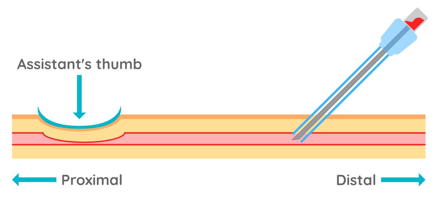 Figure 5 - When you enter the vein, a flashback of blood will appear in the needle hub. This is the most delicate stage of the procedure and it is important that you keep the stylet stable or you risk coming out of the vessel or going through the other side which will blow the vein.
