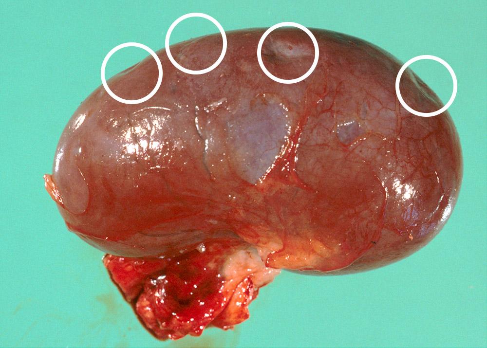 Figure 5 — Circles show the location of depressed foci on the surface of the kidney.