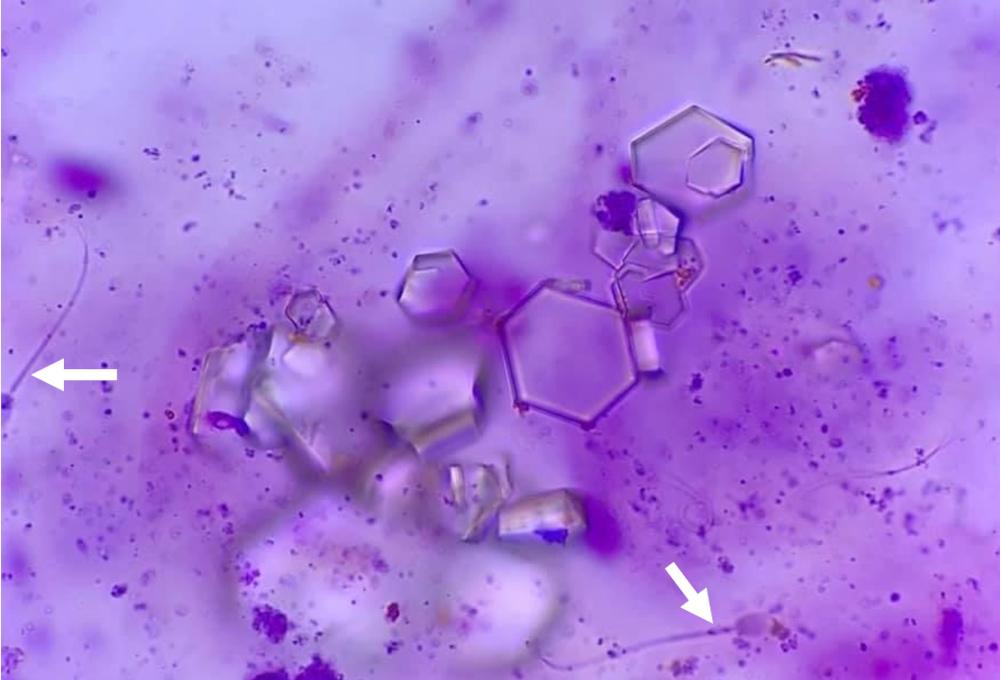 Figure 13. Cysteine crystals in a stained sample. Note the presence of spermatazoa (arrows).