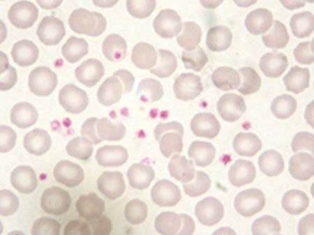 Figure 15 — Scattered platelets with prominent purple staining.