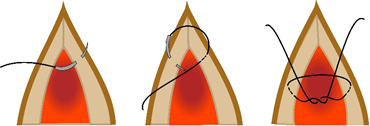 Figure 8 – Burying a square knot for an intradermal suture pattern