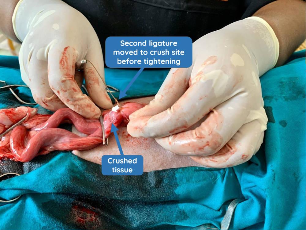 Figure 15 - Second encircling ligature loosely made and moved to crushed tissue where it is tightened.