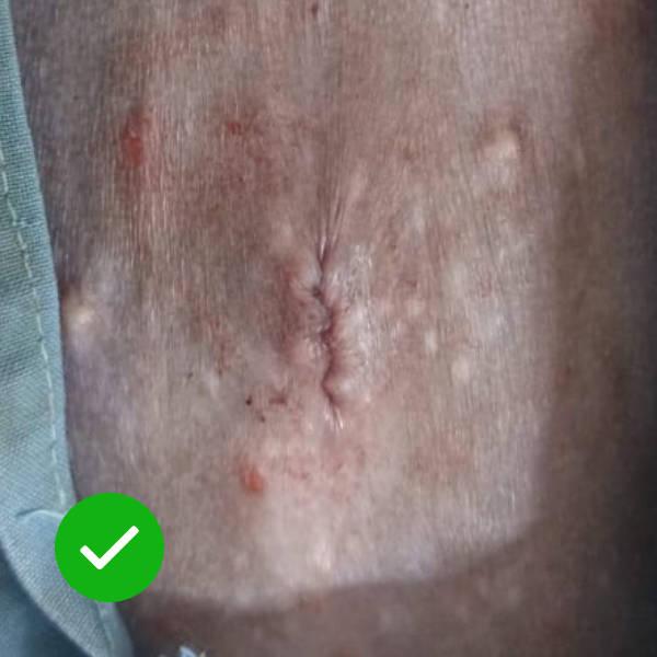 Figure 2 - Comparison of an uninfected and infected wound. The wound on the left is healing well with no signs of infection. Conversely, on the right, the surgical wound is swollen, reddened and has opened completely, with a purulent discharge. This animal requires systemic antibiotics and intensive wound management.