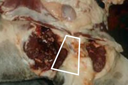 Figure 12 — Removing the right piece of free pelvic bone