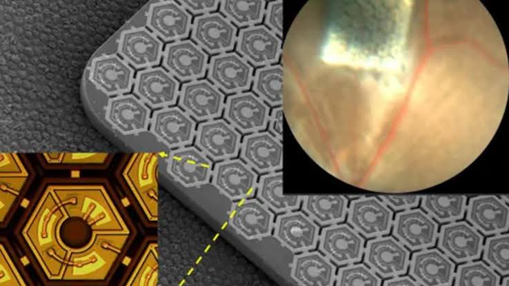 Implante en retina Implante en retina - Optica Suarez