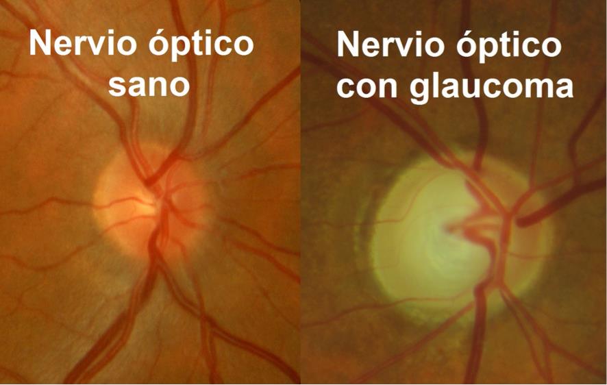 Nervio óptico afectado por glaucoma