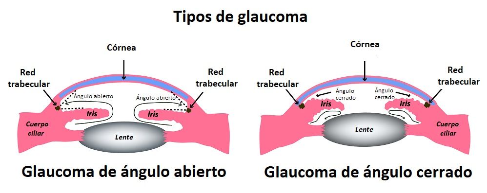 Tipos de glaucoma y cómo evitar la pérdida de visión