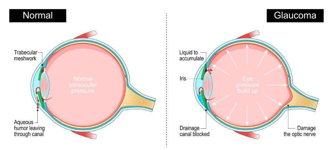 Examen ocular para detección de glaucoma en Jaén