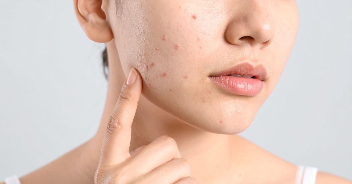 Shingles in Singapore: Myths, Symptoms & Vaccine at Alami