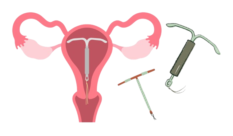 IUD/IUS