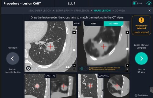Body Vision Raises Funding for AI Lung Imaging