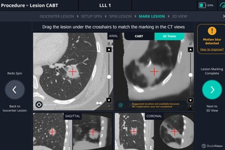 Body Vision Raises Funding for AI Lung Imaging