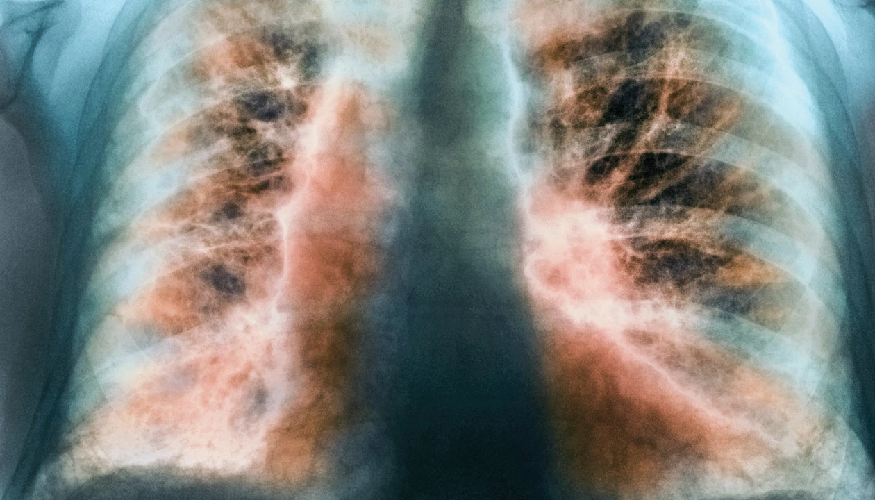 Celea launches with $180M for lung disease trial