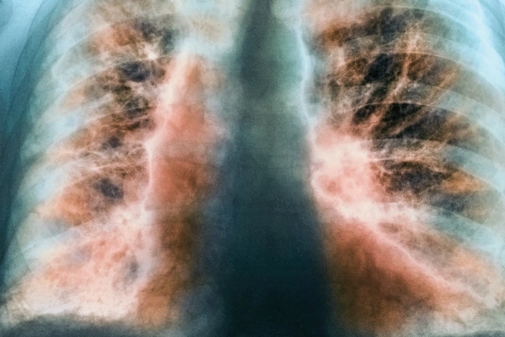 Celea launches with $180M for lung disease trial