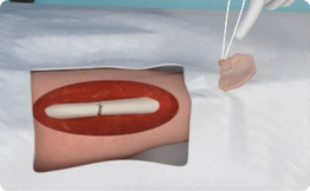 Novadip Raises €10.4M for Bone Therapy