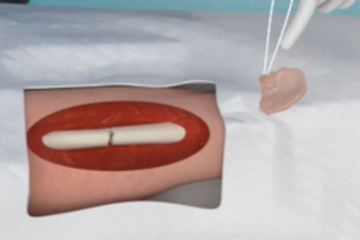 Novadip Raises €10.4M for Bone Therapy