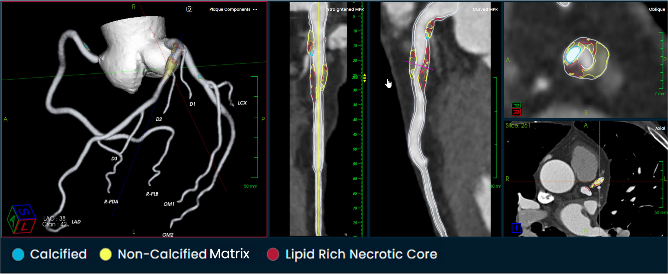 Elucid Raises $55M for Cardiac Imaging AI