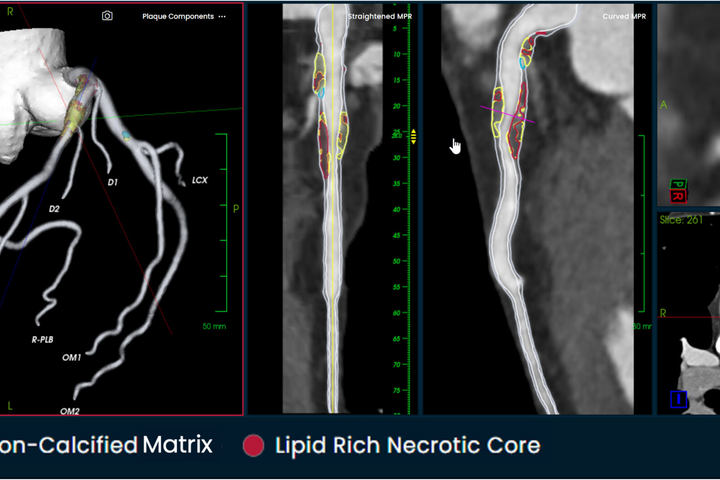 Elucid Raises $55M for Cardiac Imaging AI