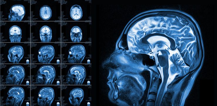 MRI Scan Report