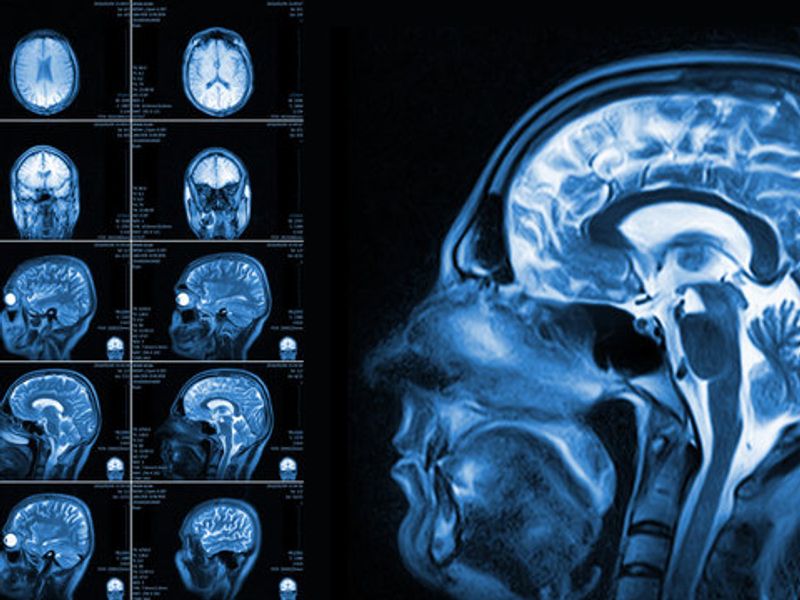 MRI Scan Report
