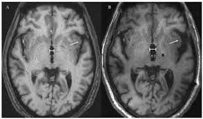 Comparison of two medical reports - MRI Scan reports