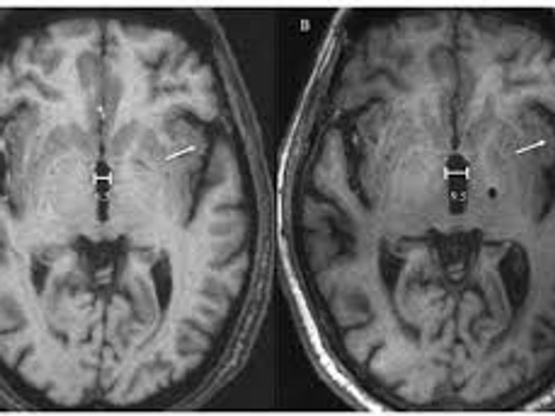 Comparison of two medical reports - MRI Scan reports