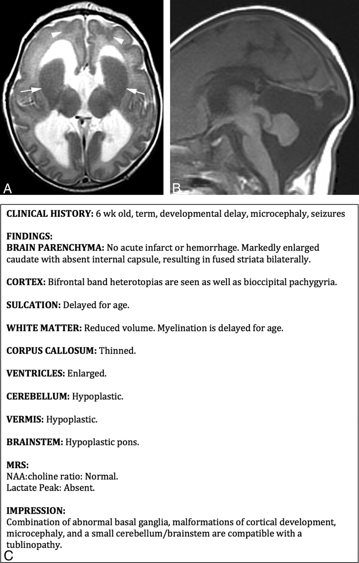 Axial and sagittal brain MRI images beside the structured radiology report describing the findings and impression