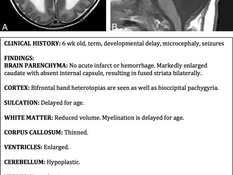 Axial and sagittal brain MRI images beside the structured radiology report describing the findings and impression