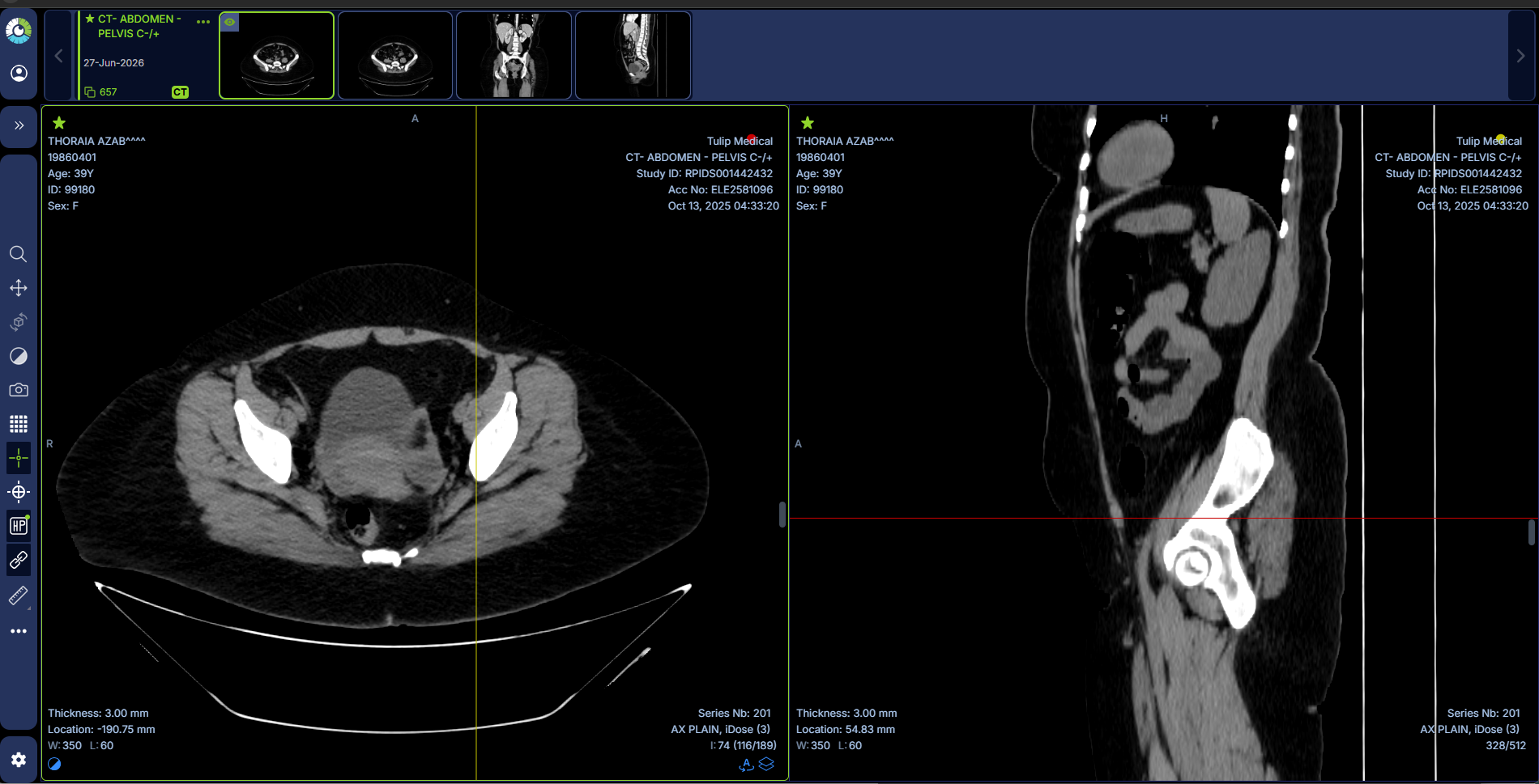 Abdomen CT raw scan