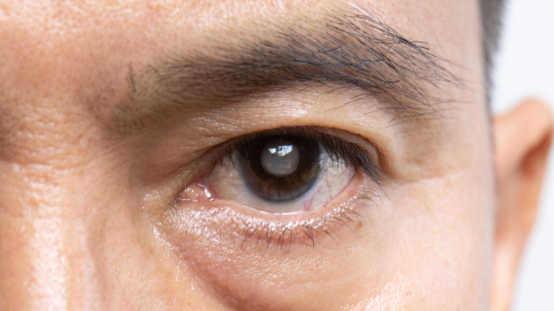 A close up of an older man's cataract affected eye.