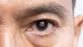 A close up of an older man's cataract affected eye.