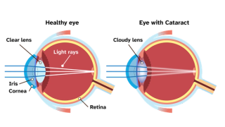 Anatomical diagram of the condition