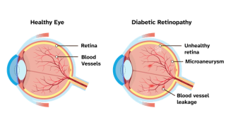 Anatomical diagram of the condition