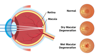 Anatomical diagram of the condition