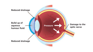 Anatomical diagram of the condition