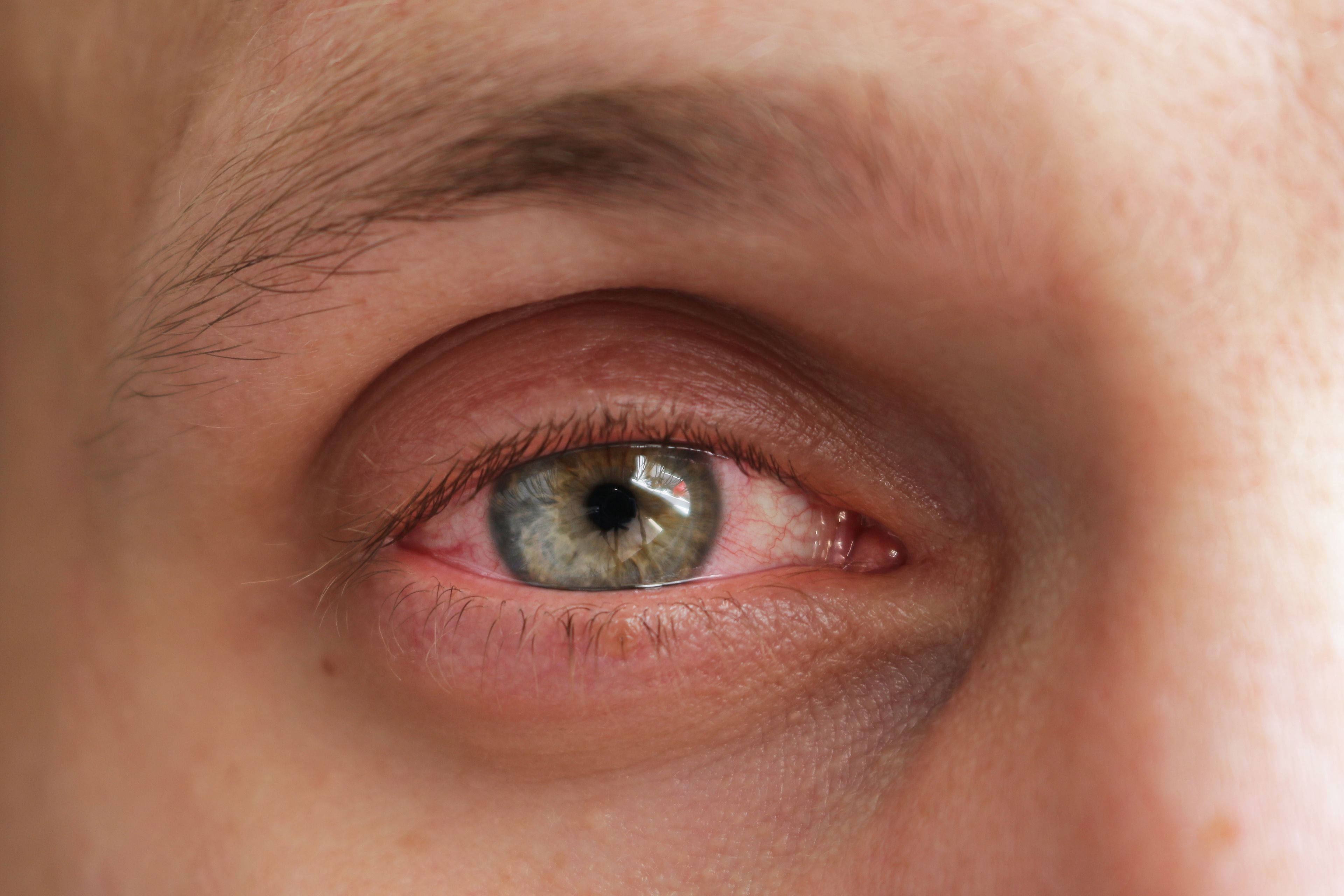 Close up on a red eye of a person with conjunctivitis