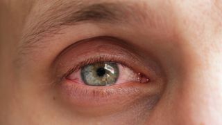 Close up on a red eye of a person with conjunctivitis