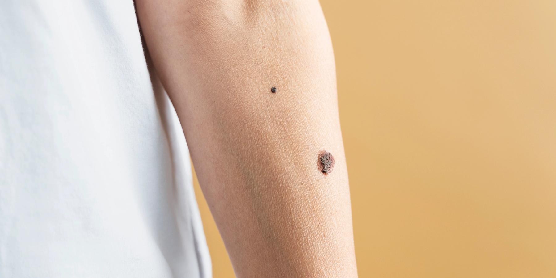 Közeli kép egy férfi karról különböző méretű anyajegyekkel