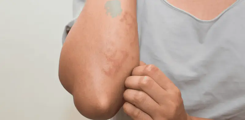 How to Reduce Tirzepatide Rashes and Itchy Injection Sites