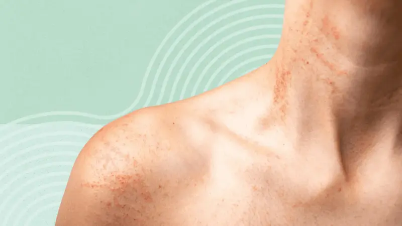Can Tirzepatide Cause Skin Rashes