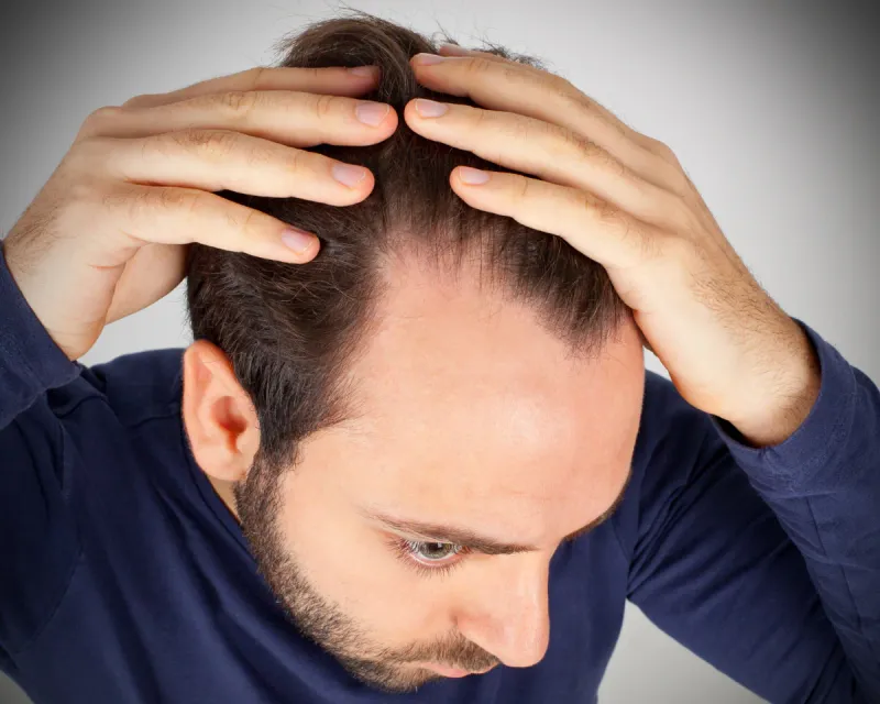 Is Tirzepatide Hair Loss Permanent