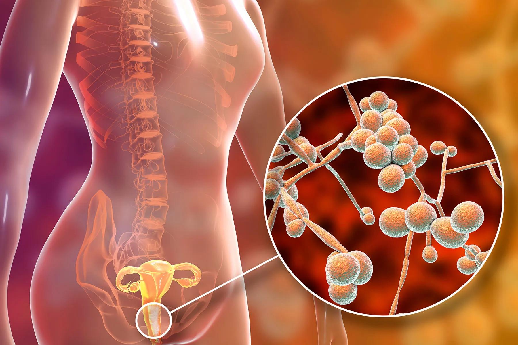 Can Wegovy Cause Yeast Infection & How Can I Treat It Safely?